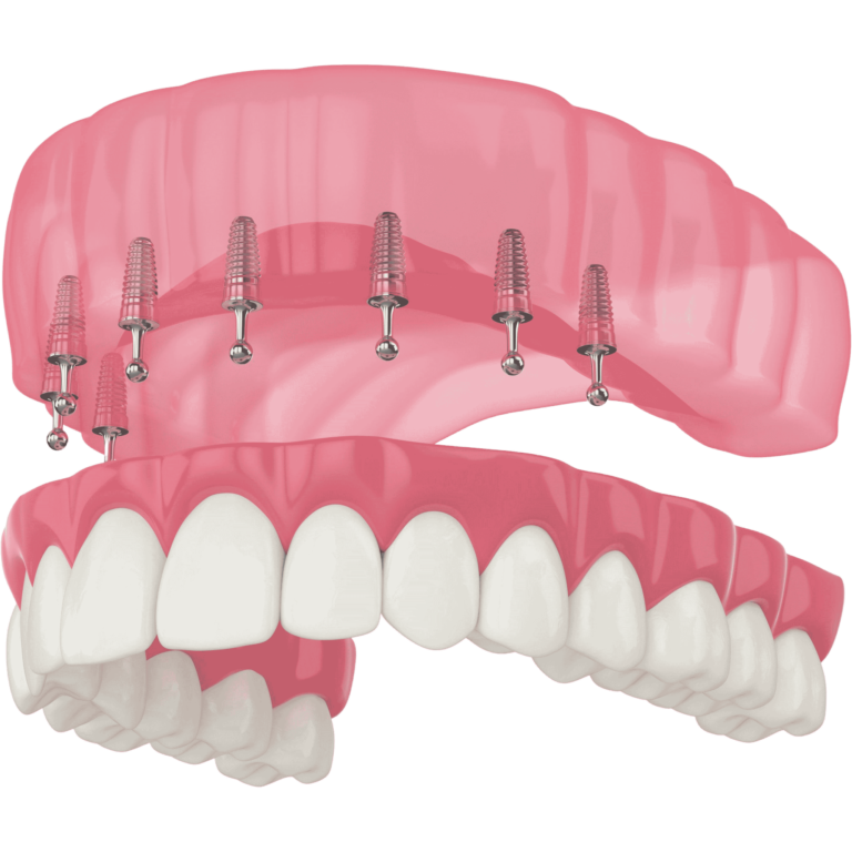 snap-on-dentures-1-768x768